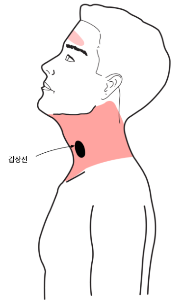 갑상선암온열법01