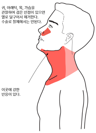 식도암온열법01