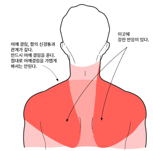 폐암온열법02